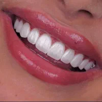 ایمپلنت بدون درد با شرایط ویژه و اقساط طولانی