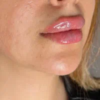 تزریق ژل و بوتاکس