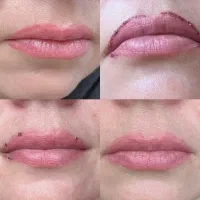 پاک کردن خط لب قرمز ، با لیزر تخصصی