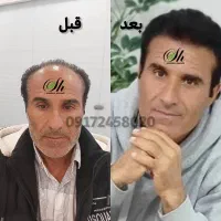 کاشت مو و ابرو و ریش اقساطی ویژه اهواز در شیراز