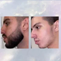 باریزش کم پشتی خداحافظی کن