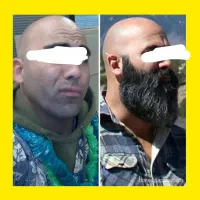 رویش ریش/ریش و سیبیل/ریزش سکه ای