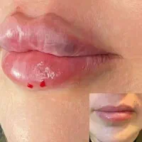 تزریق ژل و بوتاکس