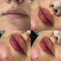 ژل بوتاکس آنزیم مزوژل