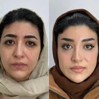 تزریق با تکنیک های جدید