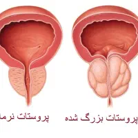 مثانه و مجاری ادراری و پروستات