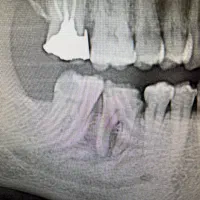 عصب کشی دندان