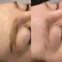 ریموو تتوی تک جلسه ای نتیجه قطعی