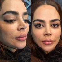 تزریق ژل های کره ای