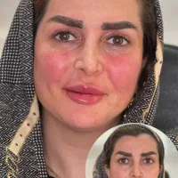 تزریق ژل و بوتاکس ویژه مرداد