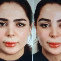 تزریق بوتاکس و ژل   تخفیف ویژه