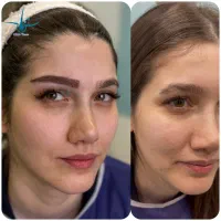 کاشت ابرو ونوس ، میکروکاشت vip زعفرانیه پالادیوم