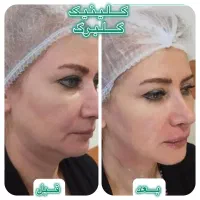 هایفو تراپی درمان و رفع شلی و افتادگی پوست(گلبرگ)
