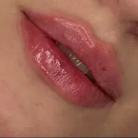 تزریق ژل لب  و صورت بوتاکس جوانساز مزوژل فیلر