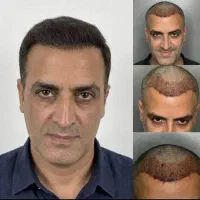 کاشت مو به روش میکروگرافت