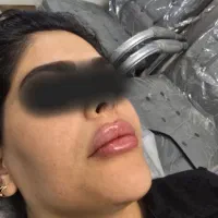 جشنواره لیزر بوتاکس فیلر پی آرپی زگیل مزو لاغری