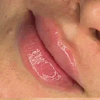 خدمات  ژل صورت و بوتاکس و جوانساز و مزوتراپی