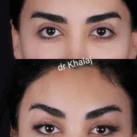 جشنواره عمل لیفت شقیقه فول فیس و بینی دکتر خلج