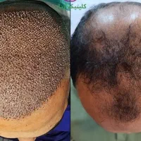 بهترین دکتر کاشت مو معرفی بفرمائید