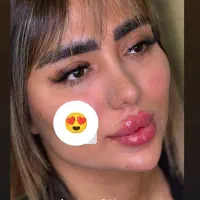 آف ویژه تزریقات و آموزش ژل و بوتاکس