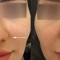 ساکشن و چربی سوزی بینی .کوچیک کردن بینی