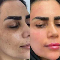ضدلک ایتالیایی