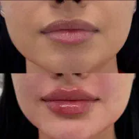هدیه ویژه برای لیزر اولی ها فقط تا پایان این ماه