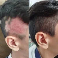 پسرهای کچل کنسلن