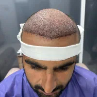 کاشت مو اقساط گچساران