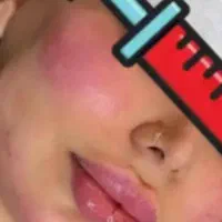 ساکش شکم و پهلو و تزریق چربی و ژل