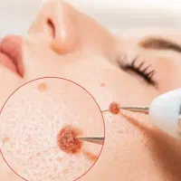 لیزر زگیل hpvخال،میخچه.لیزر تتو ،هموروئید پیرسینگ