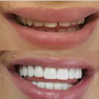 جشنواره دندانپزشکی ، زیبایی ، روکش