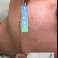 آموزش تخصصی درماپلنینگ با تلفیق پکیج های حرفه ای