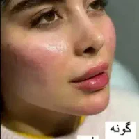 ژل و بوتاکس