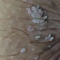 درمان زگیل تناسلی و هرپس و عفونت زنان