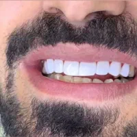 کامپوزیت دندان تخفیف بهاری فکی ۱۴ تومن
