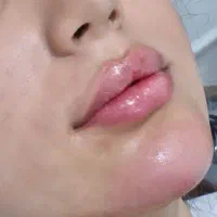 تزریق ژل وبوتاکس و آموزش   ،پی ارپی ، بایوفیلر