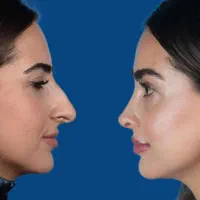 کلینیک زیبایی/ جراحی بینی / رینوپلاستی