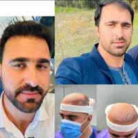 کاشت مو وابرو در کلینیک تخصصی در تبریز