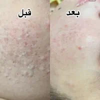 فیشیال تخصصی پوست VIP