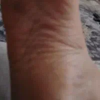 کف سابی پا و ناخن و فشیال