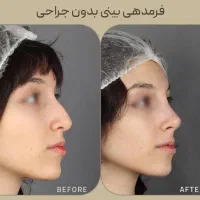 فرمدهی بینی Noa بدون عمل Dr ژل مو ابرو غبغب زیبایی