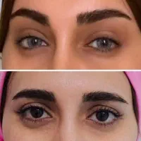 آف باورنکردنی لیفت شقیقه و لیپوساکشن تخصصی