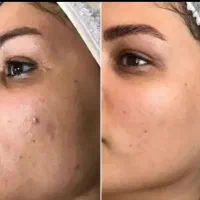 فشیال پاکسازی پوست پی آر پی کربوکسی درمان جوش