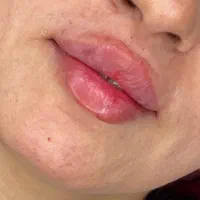 ژل لب ۷۰۰ بوتاکس ۷۰۰ آنزیم ۶۰۰
