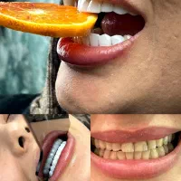 (دندانپزشکی)با شرایط اقساط کامپوزیت کن
