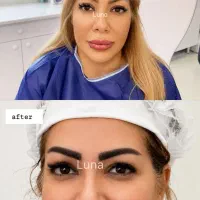 مدل کاشت ابرو نچرال