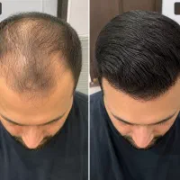 رفع ریزش مو و رشد مجدد تضمینی