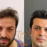 کاشت مو، ابرو و ریش(تخصصی و تضمینی)