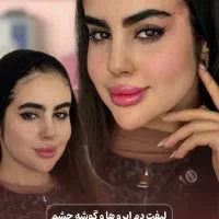 تزریق ژل لب پروفایلو بوتاکس